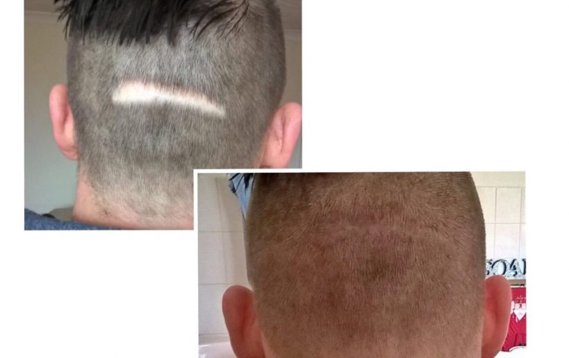 scalp micropigmentation specialist