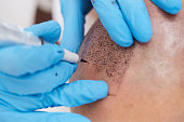 Scalp Micropigmentation