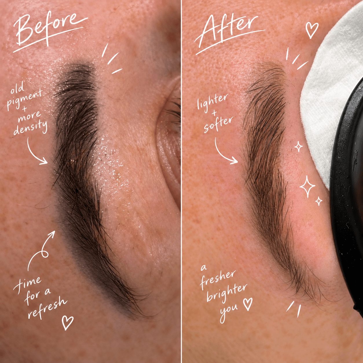 laser lightening results from 1 session of laser on tattooed eyebrows. brows go from looking saturated and dark and the worng tone to soft and ligt with no damage to skin