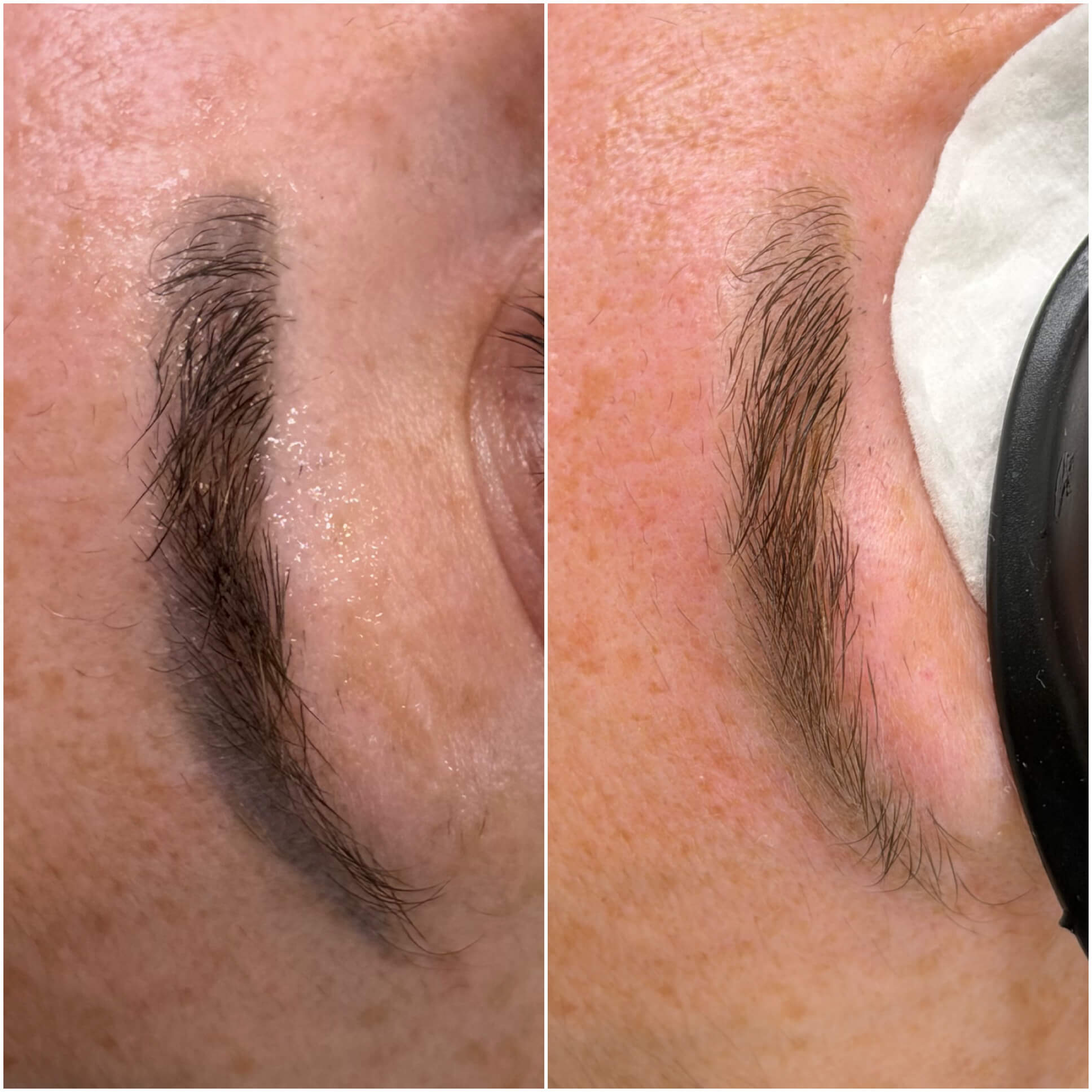 Before and immediately after one laser-lightening session on saturated permanent makeup eyebrows.